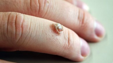 how to get rid of finger warts