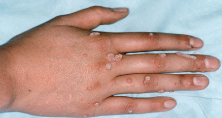 how to remove warts